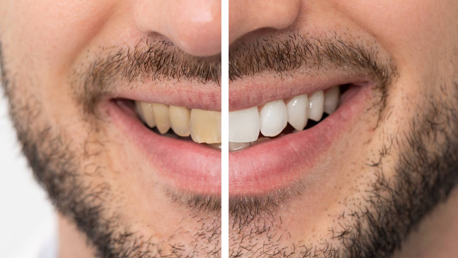 How to Naturally Whiten Your Teeth: Effective Home Remedies and Tips